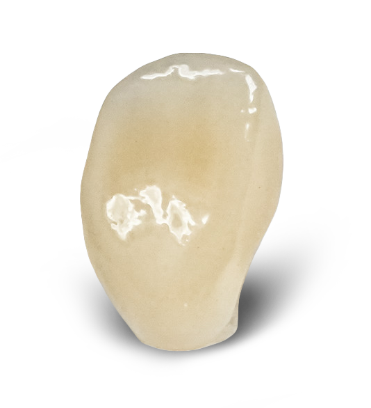 IPS e.max® Monolithic